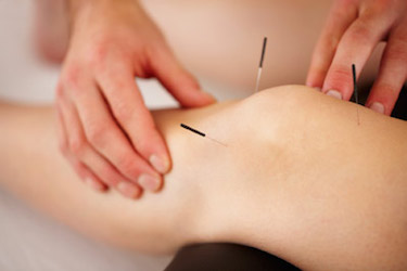 acupuncture-2